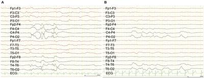 Case Report: Subtotal Hemispherotomy Modulates the Epileptic Spasms in Aicardi Syndrome